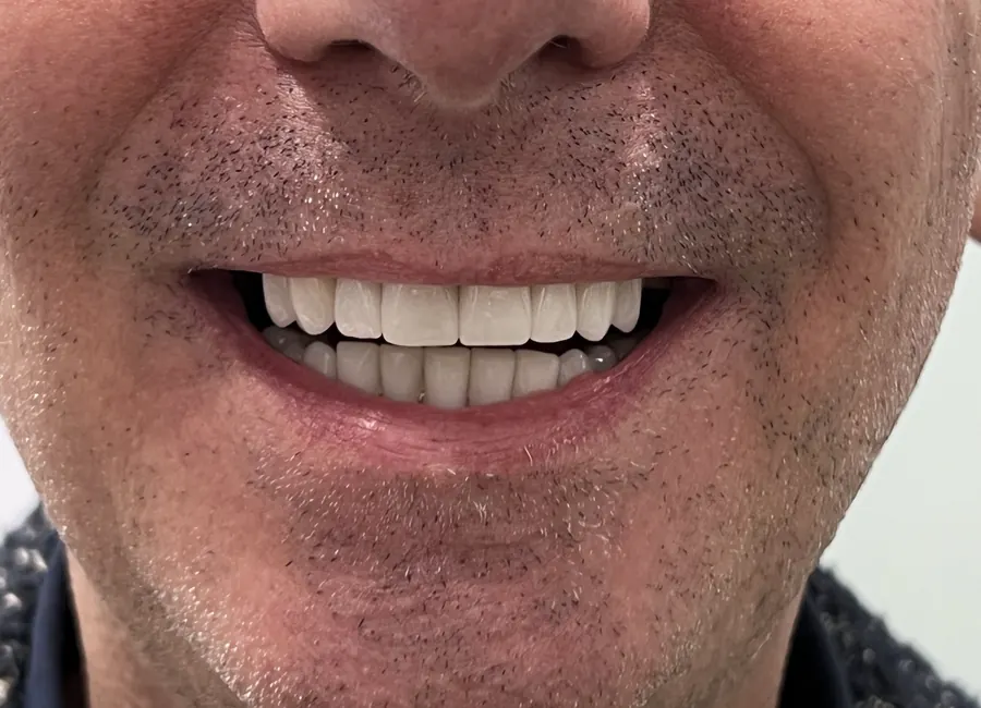 Alessandro, dopo l’All-on-4