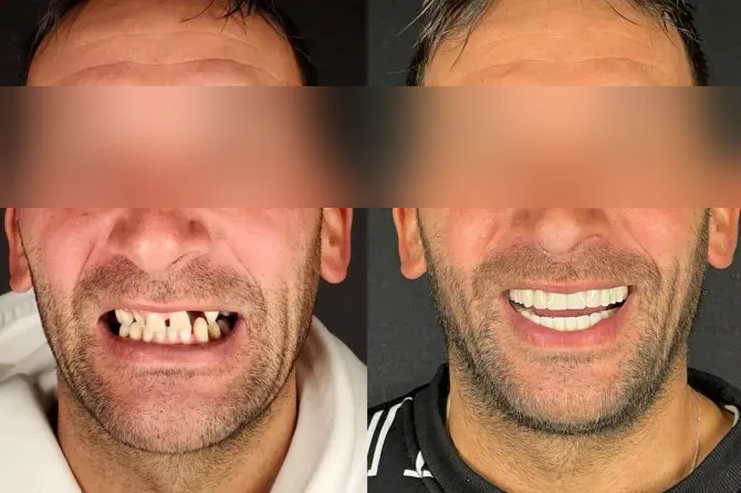 Paziente Kena prima e dopo la riabilitazione con impianti