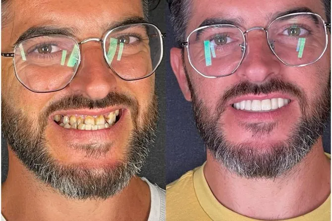 Paziente Kena prima e dopo il rifacimento estetico