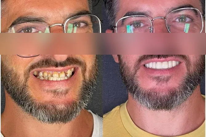 Paziente Kena prima e dopo il rifacimento estetico