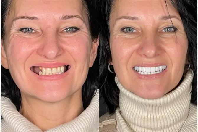 Paziente Kena prima e dopo denti fissi