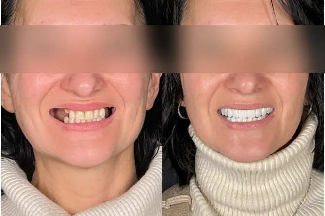 Paziente Kena prima e dopo denti fissi