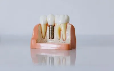 Modello che mostra un impianto dentale nell’osso