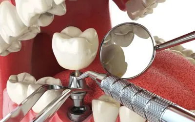 Quanto dura un impianto dentale