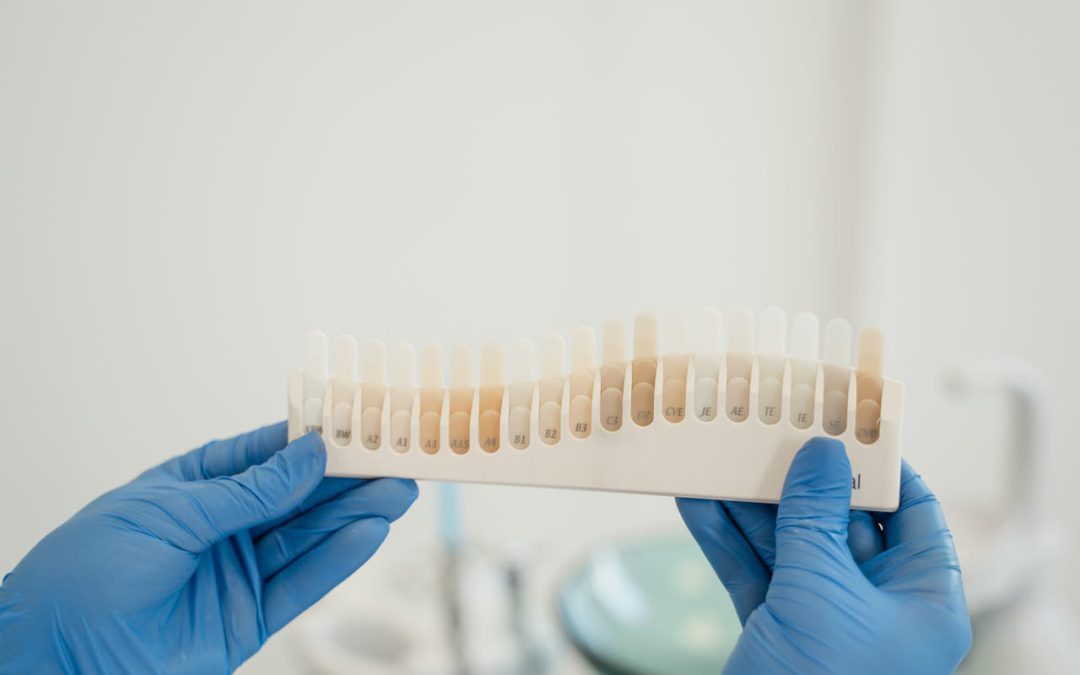 Tabella delle tonalità dentali tenuta da un dentista con guanti blu, utilizzata per valutare il colore dei denti prima e dopo lo sbiancamento laser.