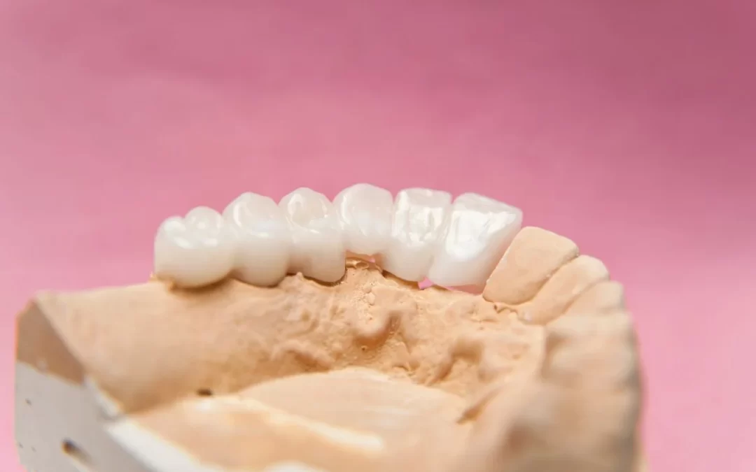 Modello odontoiatrico con protesi dentaria fissa in ceramica su gengiva artificiale, sfondo rosa.